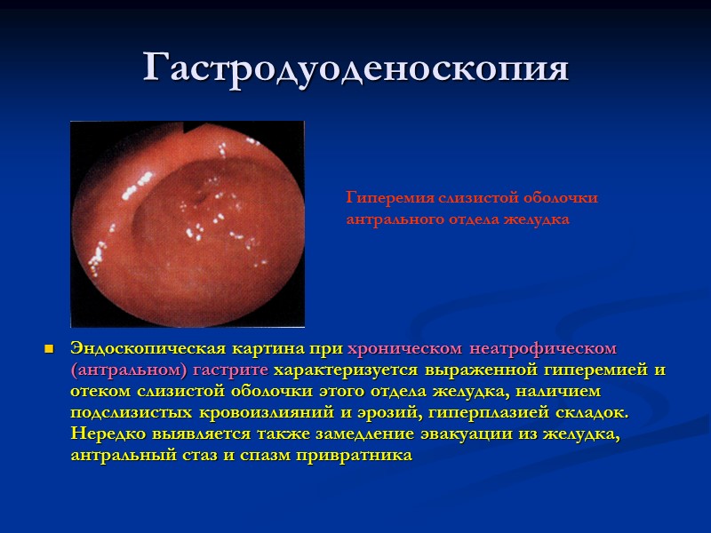 Гастродуоденоскопия Эндоскопическая картина при хроническом неатрофическом (антральном) гастрите характеризуется выраженной гиперемией и отеком слизистой
